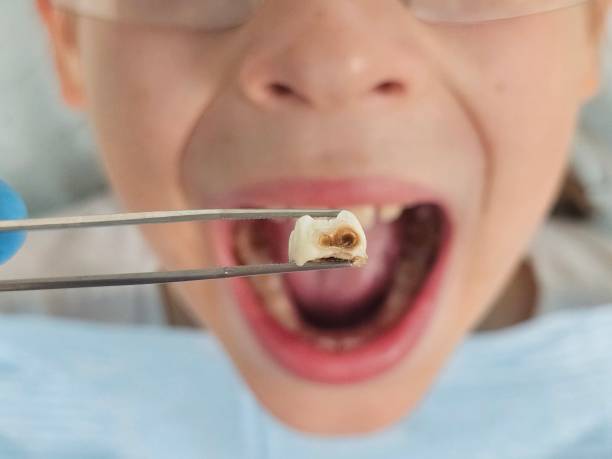 Best Emergency Dentist for Knocked-Out Tooth in Clyde Hill, WA